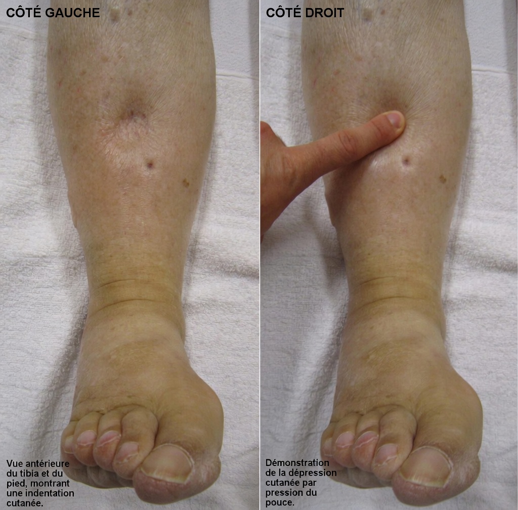 Quels sont les 12 effets secondaires les plus courants de l’amlodipine et les habitudes quotidiennes qui peuvent faire la différence ?