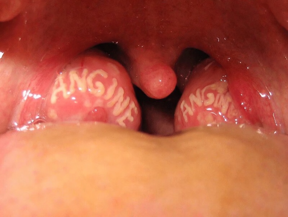 Que sont ces bosses blanches dans votre bouche et pourraient-elles être liées à des habitudes quotidiennes courantes ?