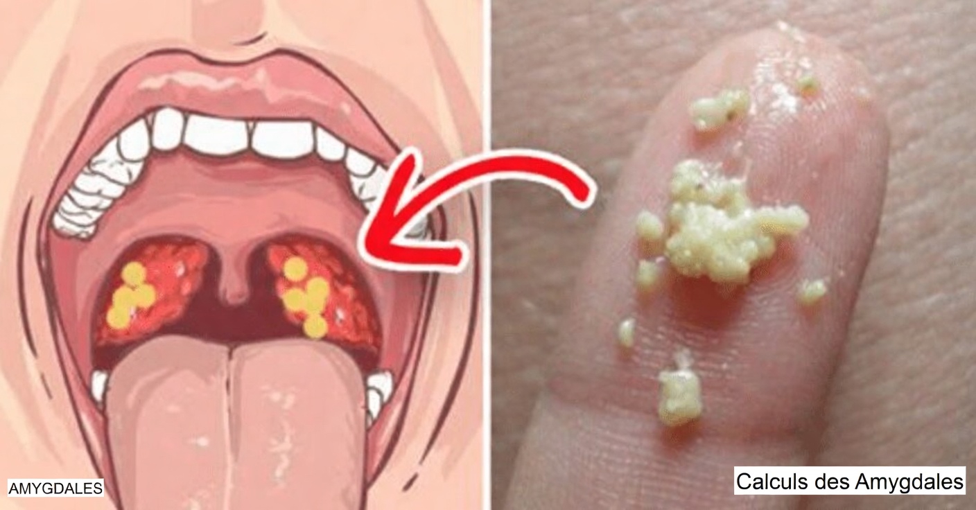 Que sont ces bosses blanches dans votre bouche et pourraient-elles être liées à des habitudes quotidiennes courantes ?