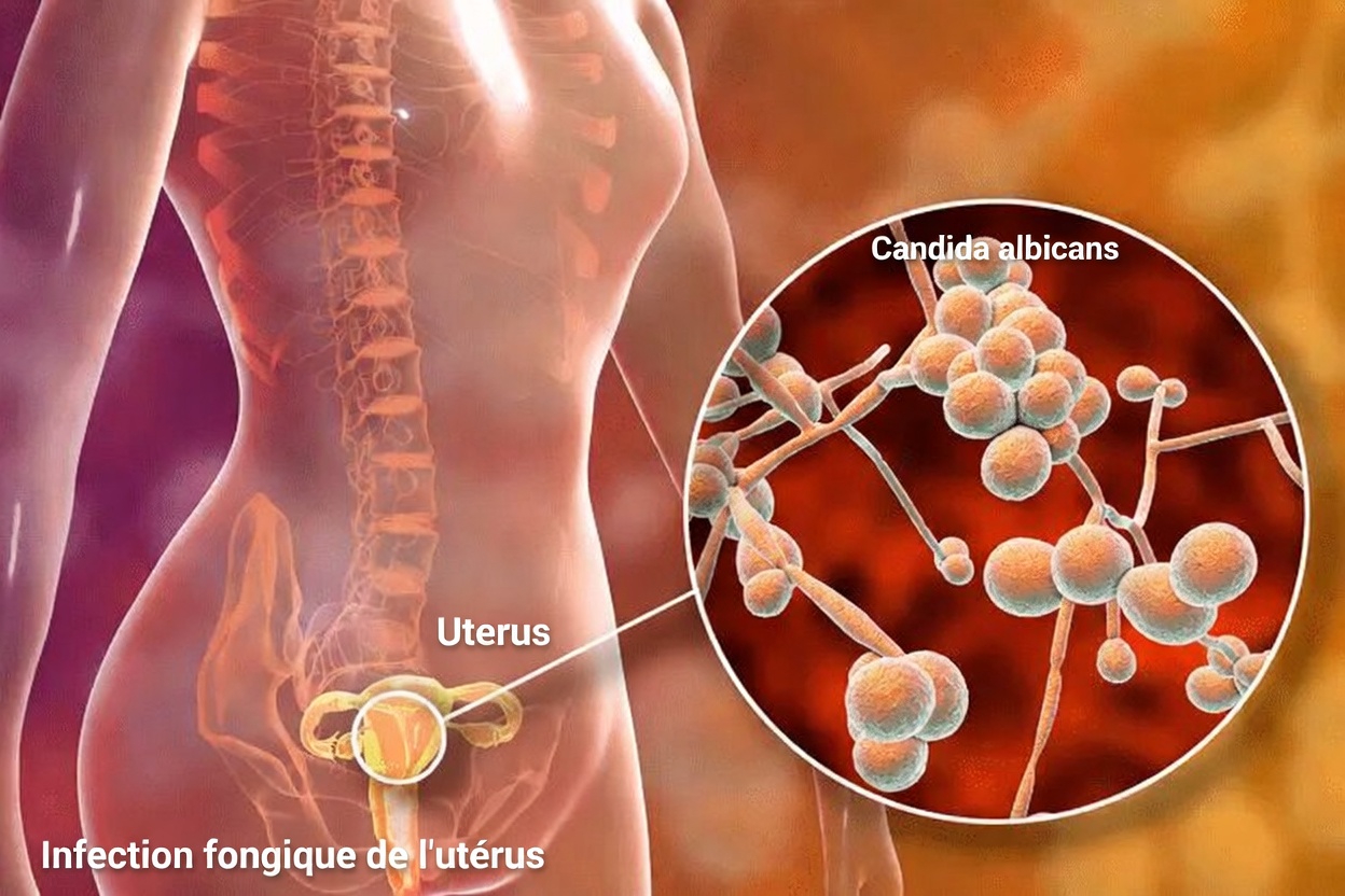 Quels sont les signes courants d’une mycose vaginale que chaque femme devrait connaître ?