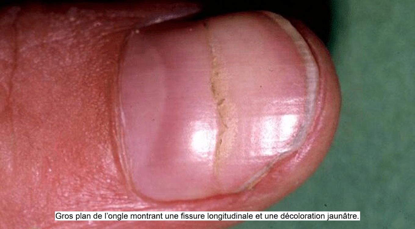 Que signifient vraiment ces stries sur vos ongles ? De simples habitudes quotidiennes pour favoriser des ongles en meilleure santé