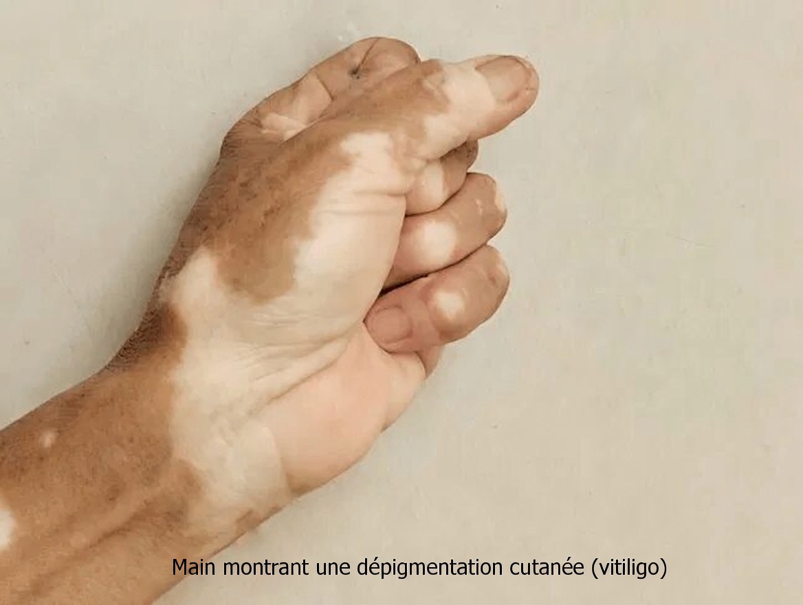 Pourquoi des taches blanches apparaissent-elles sur vos bras et vos jambes ? Comprendre les causes fréquentes et les conseils de soins de la peau