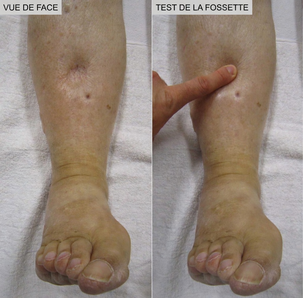 Quels sont les 12 effets secondaires les plus courants de l’amlodipine et les habitudes quotidiennes qui peuvent faire la différence ?