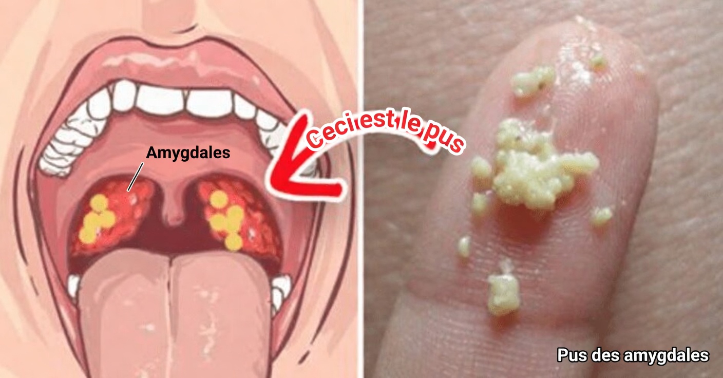 Que sont ces petites bosses blanches dans votre bouche et pourraient-elles être liées à des habitudes quotidiennes courantes ?