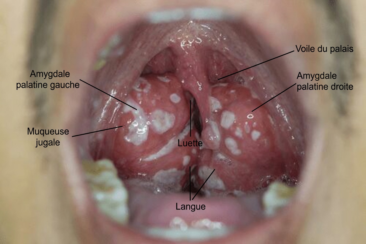 Voici la vérité dérangeante sur les calculs amygdaliens et les simples habitudes quotidiennes à connaître