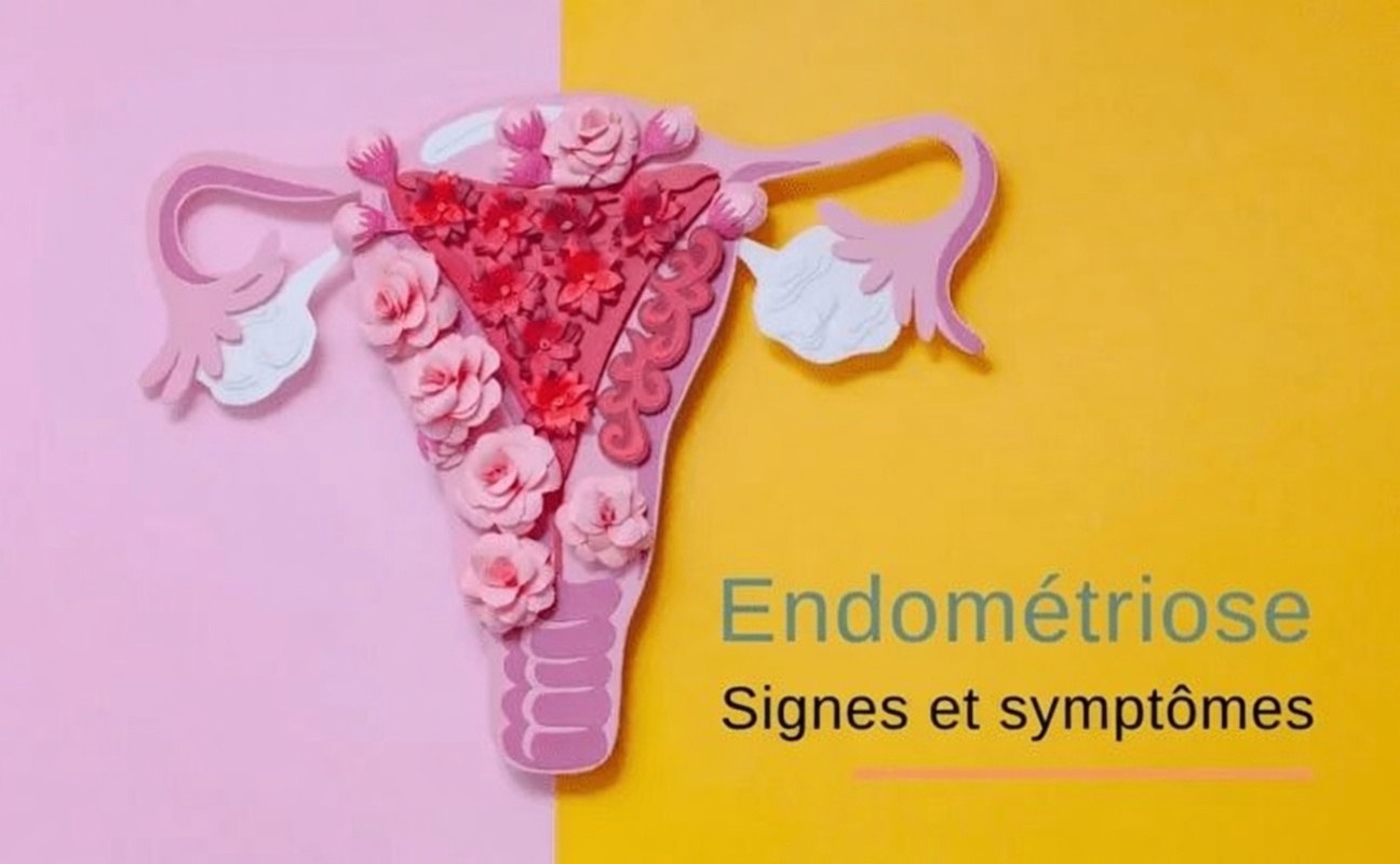 Ce que chaque femme devrait savoir sur l’endométriose : symptômes, faits et conseils pratiques au quotidien