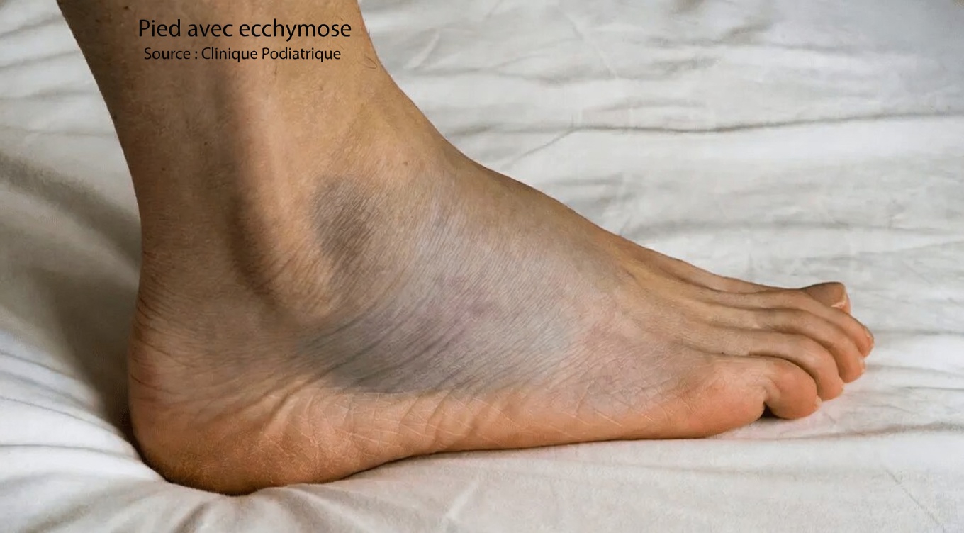 10 effets secondaires courants de l’amlodipine que vous devez connaître si vous prenez ce médicament populaire contre l’hypertension