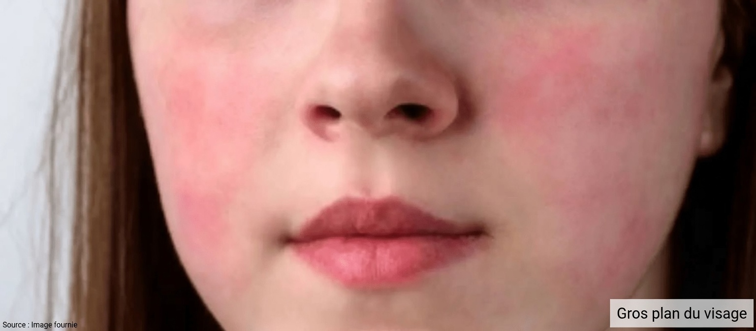 12 effets secondaires courants de l’amlodipine que vous devriez connaître et comment les gérer en toute sécurité