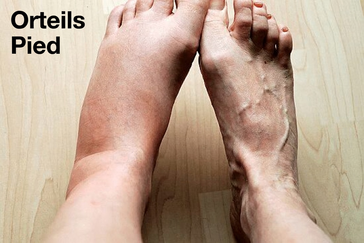 Ce que des jambes enflées peuvent révéler sur votre santé – et pourquoi c’est important