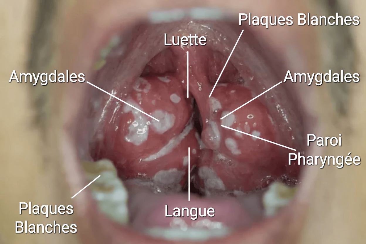 Calculs amygdaliens : ce qu’ils sont, pourquoi ils apparaissent et de simples habitudes quotidiennes pour les gérer