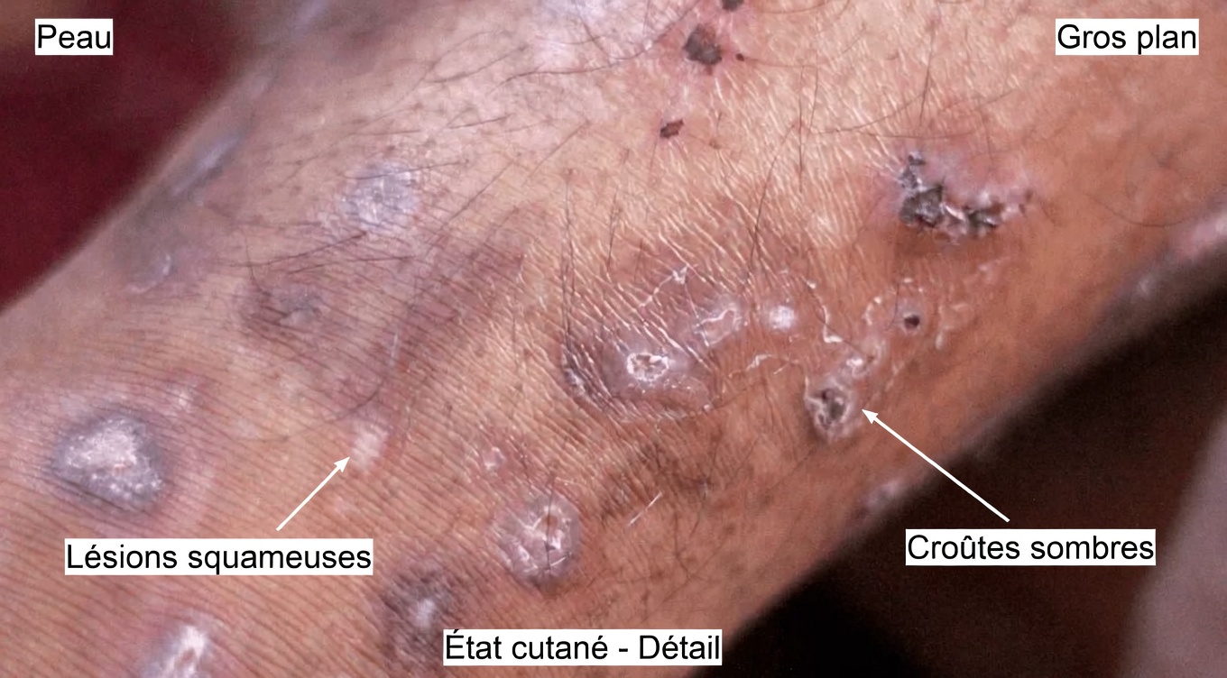 12 signes de cirrhose du foie que vous devriez connaître pour mieux prendre conscience de la santé de votre foie