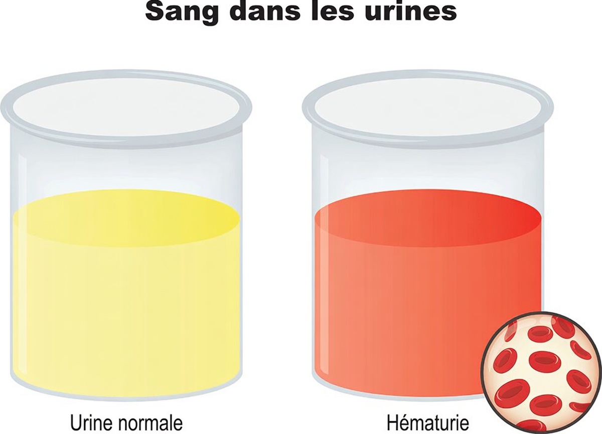 6 signes de maladie rénale qui peuvent apparaître dans votre vie quotidienne et pourquoi ils sont importants