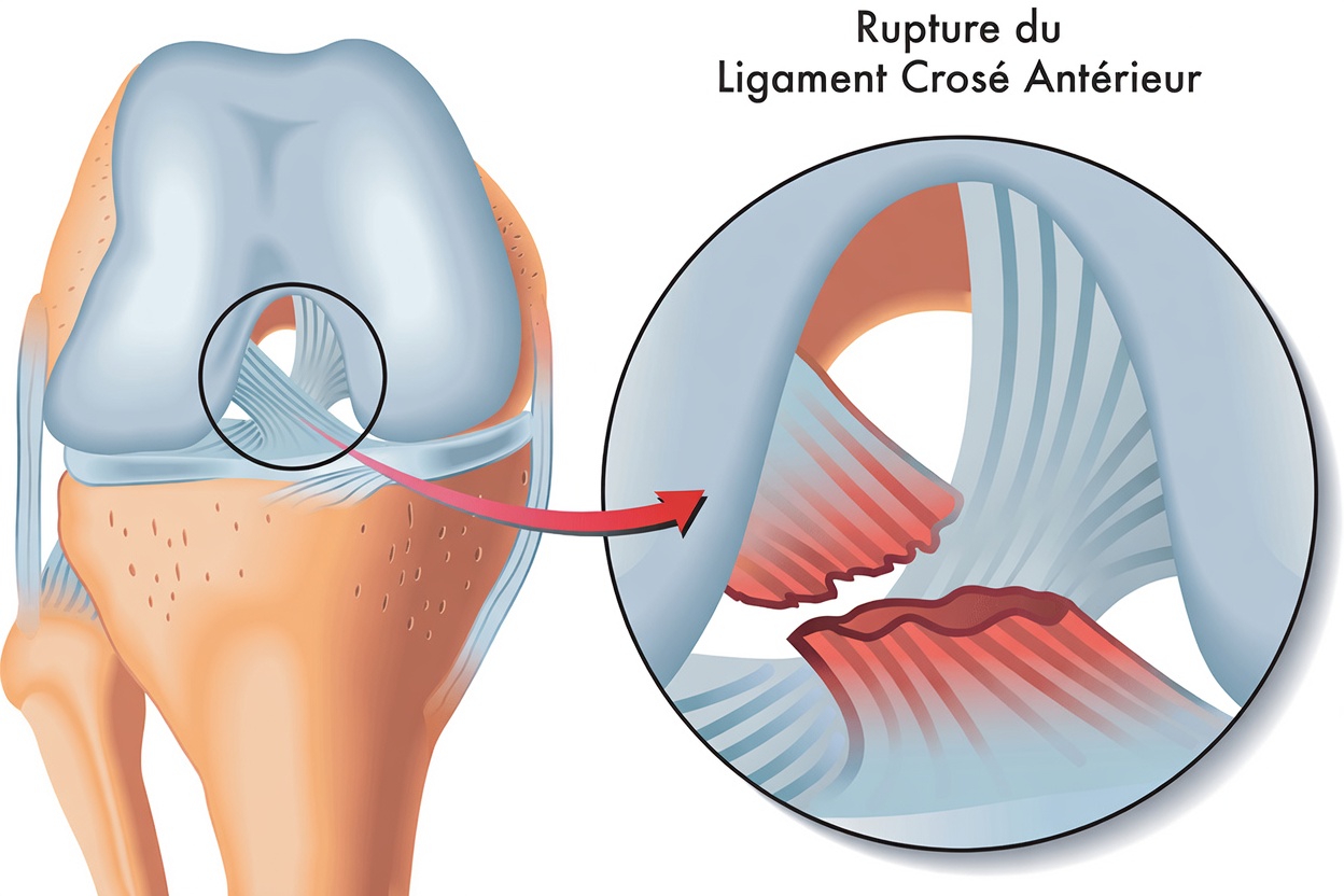 Déchirure du LCA expliquée : ce qui arrive au genou lorsque le ligament croisé antérieur se déchire – points clés