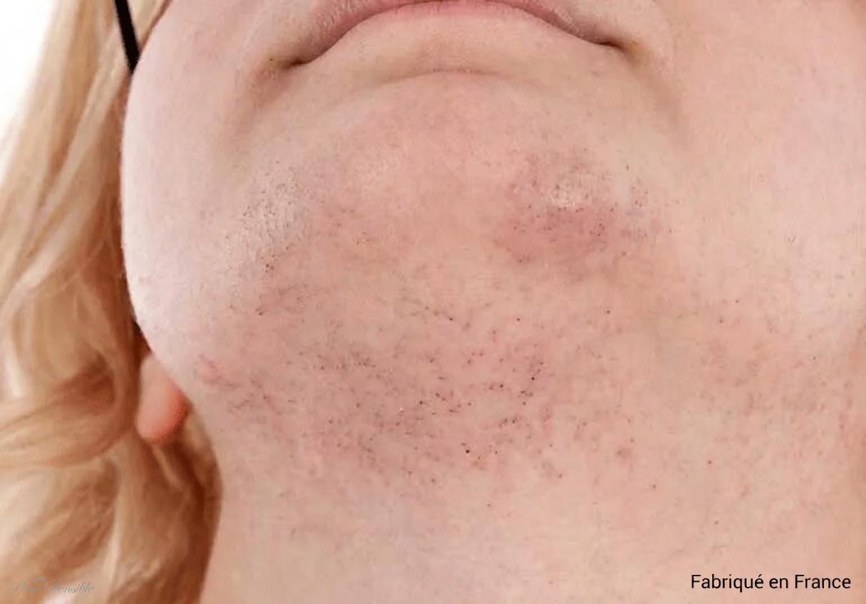 Poils au menton chez les femmes : quelles en sont les causes et quand faut-il prêter attention à ses hormones ?