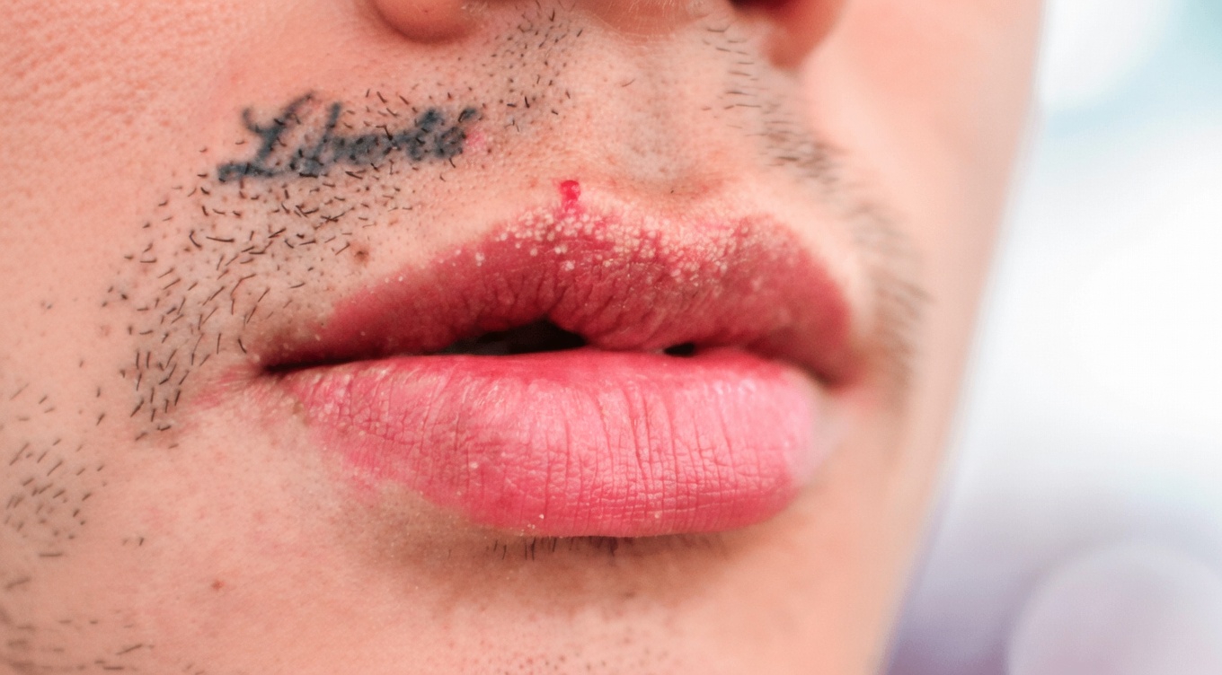 Pourquoi les gens ont-ils d’étranges petites bosses blanches sur les lèvres ou les parties intimes ? Un guide simple pour comprendre