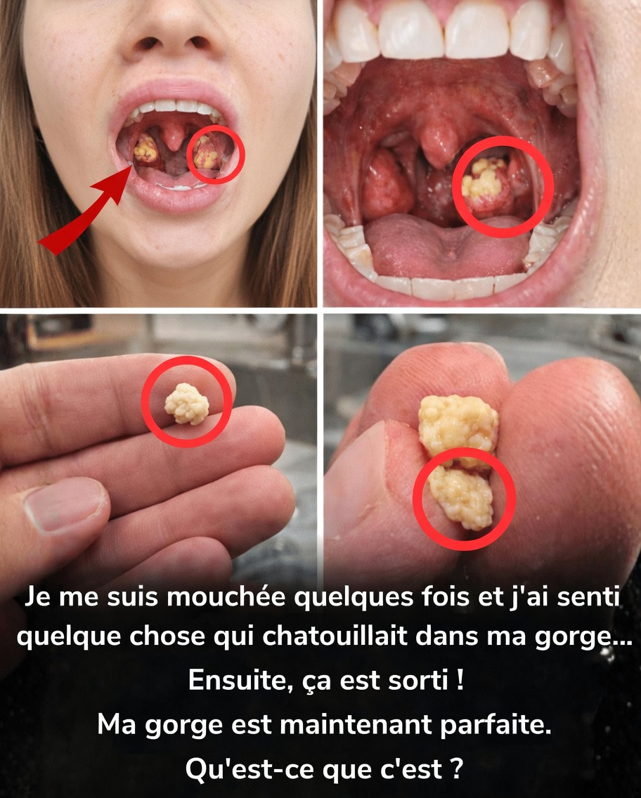 Quelle est cette drôle de boule que vous avez crachée après avoir éternué ? À la découverte des calculs amygdaliens et de ce qu’ils signifient