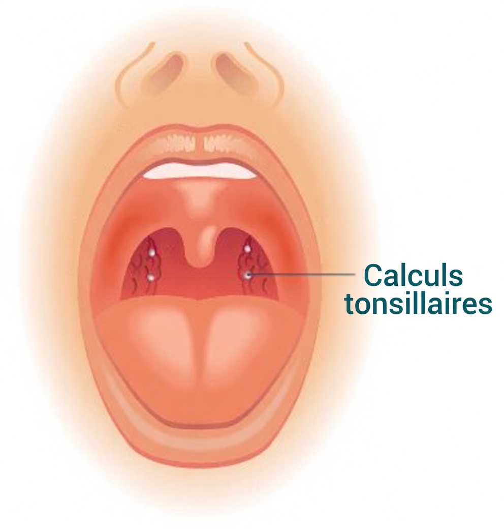 Quelle est cette drôle de boule que vous avez crachée après avoir éternué ? À la découverte des calculs amygdaliens et de ce qu’ils signifient