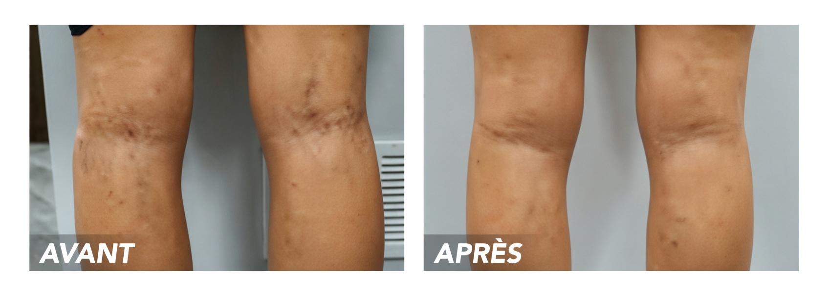 Le remède secret de grand-mère contre les varices : pourquoi de nombreuses personnes de plus de 50 ans s’intéressent à l’aloe vera, au vinaigre de cidre et au citron pour le confort des jambes