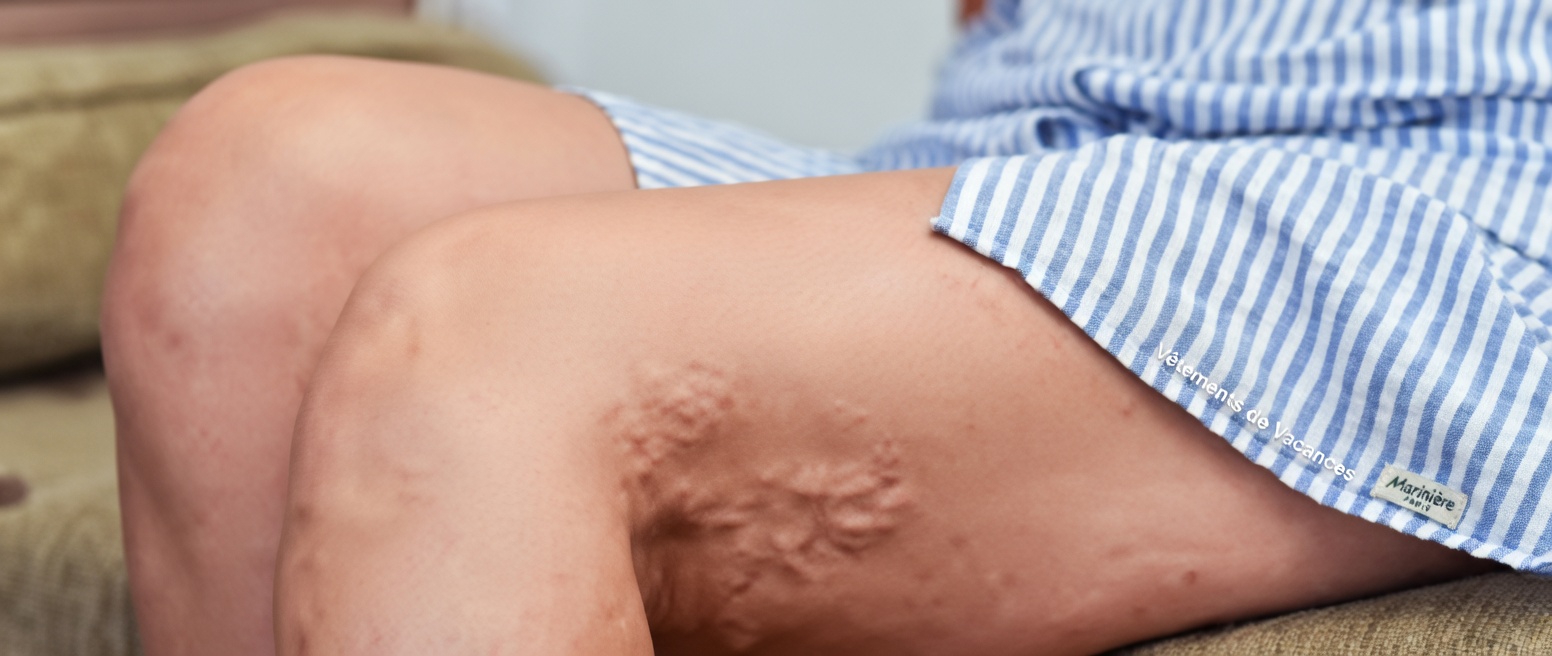 Ail, clous de girofle et gingembre : une approche naturelle pour favoriser la circulation et soulager l’inconfort des varices