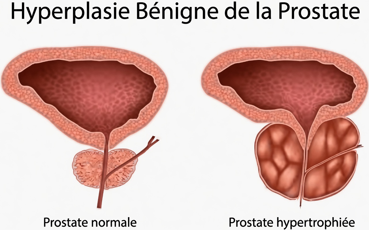 La boisson aux herbes qui pourrait soutenir naturellement la santé de la prostate (une approche douce du bien-être au quotidien)