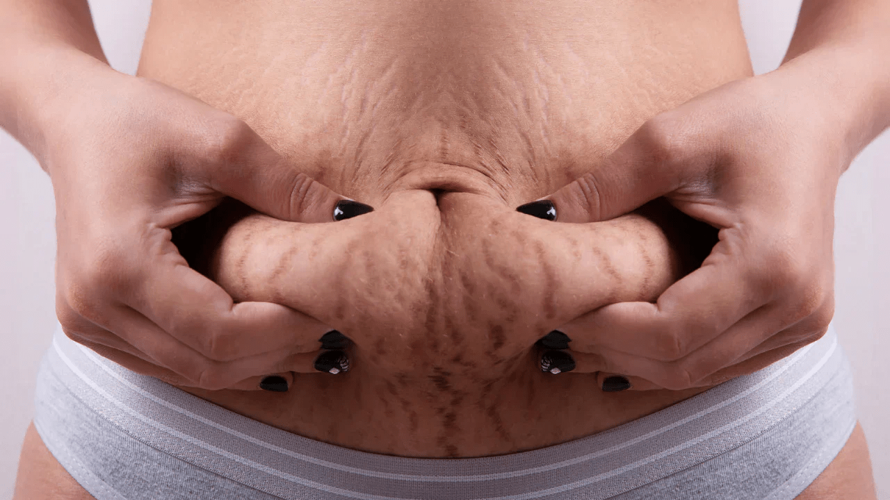 Comment prendre soin de votre peau pendant la grossesse et les changements de la vie : des habitudes simples qui aident à minimiser l’apparence des vergetures