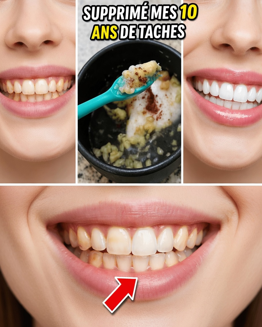 Essayez cette astuce facile de 2 minutes au blanchiment des dents à l’ail avec des ingrédients de cuisine pour un sourire plus éclatant