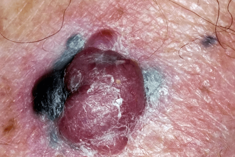 Les 14 signes avant-coureurs du cancer que vous ne devriez jamais ignorer – un dépistage précoce pourrait vous sauver la vie