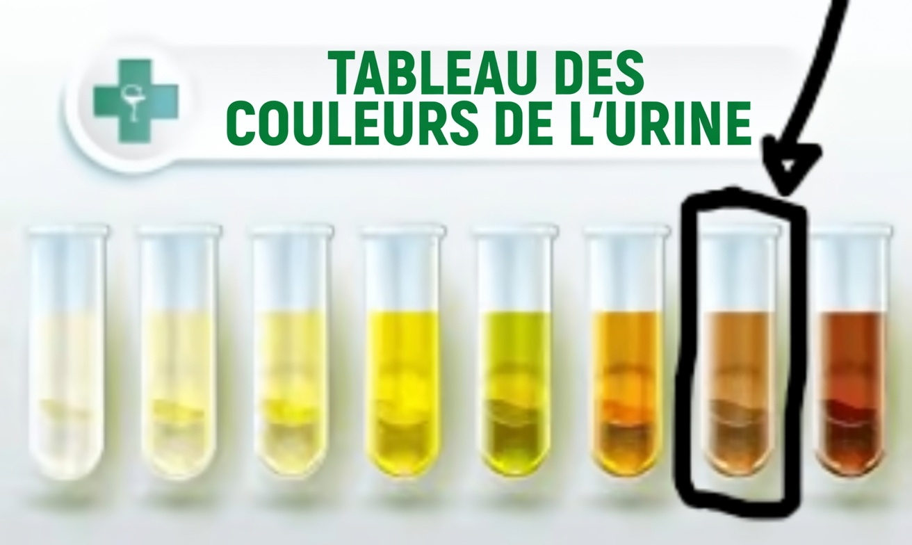 12 signes de cirrhose du foie à connaître et des moyens pratiques de protéger votre foie