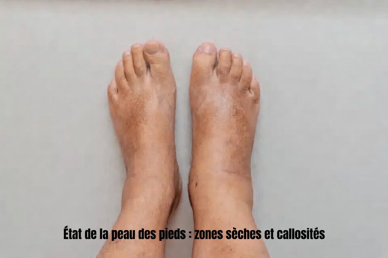 12 signes de cirrhose du foie à connaître et des moyens pratiques de protéger votre foie