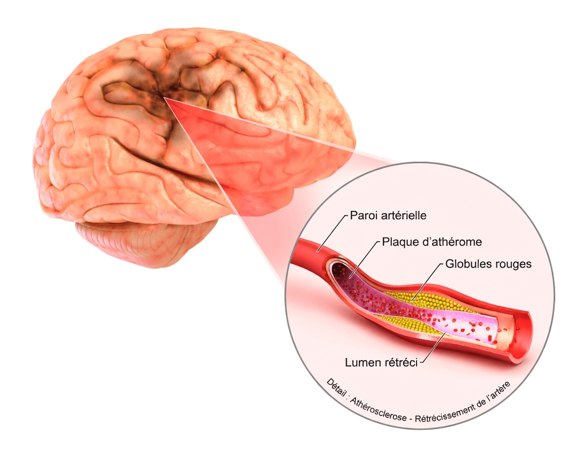 10 symptômes silencieux de mini-AVC après 60 ans souvent ignorés (surtout le n°4 – le drapeau rouge du « trou de mémoire »)