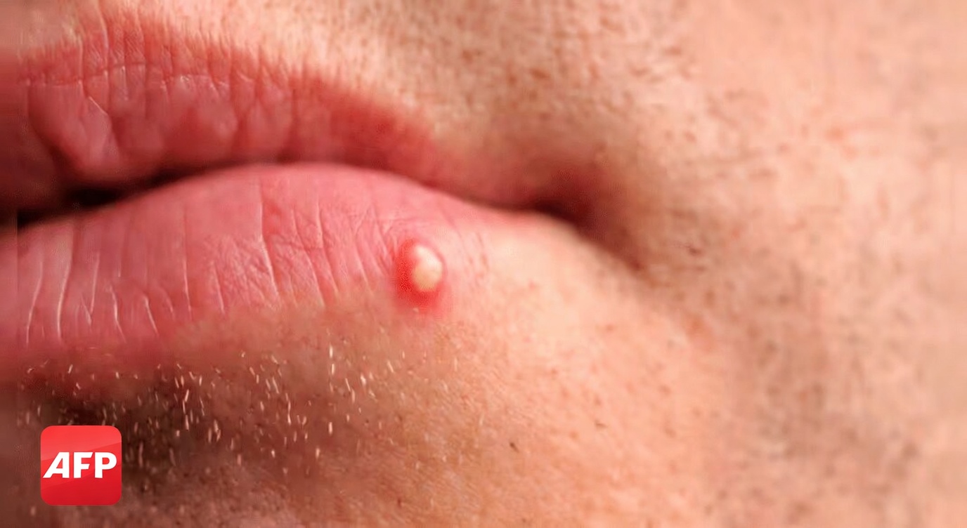 Pourquoi vous pourriez remarquer d’étranges petites bosses blanches sur vos lèvres ou vos parties intimes et ce que cela signifie