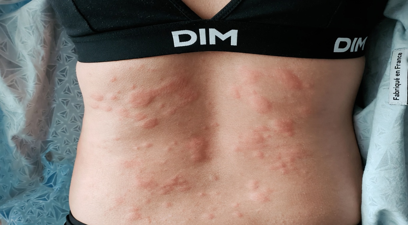 Causes surprenantes de l’urticaire révélées : ce qui pourrait déclencher ces démangeaisons et boutons sur votre peau