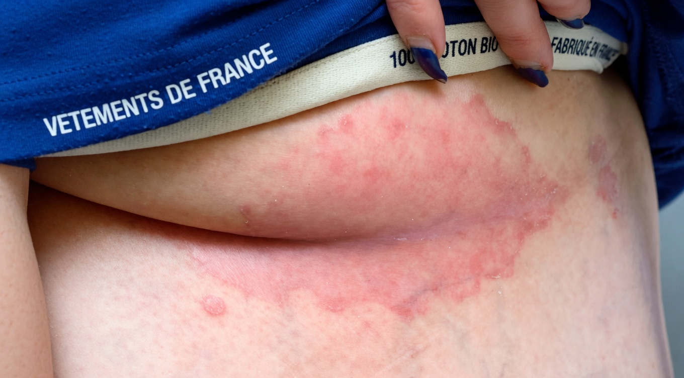 Causes surprenantes de l’urticaire révélées : ce qui pourrait déclencher ces démangeaisons et boutons sur votre peau