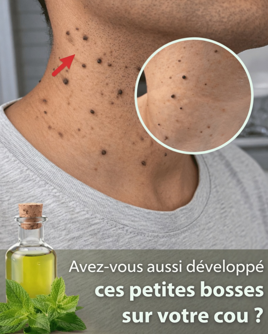 Si vous remarquez de petits morceaux de peau sur votre cou ou vos aisselles, voici ce que cela peut signifier