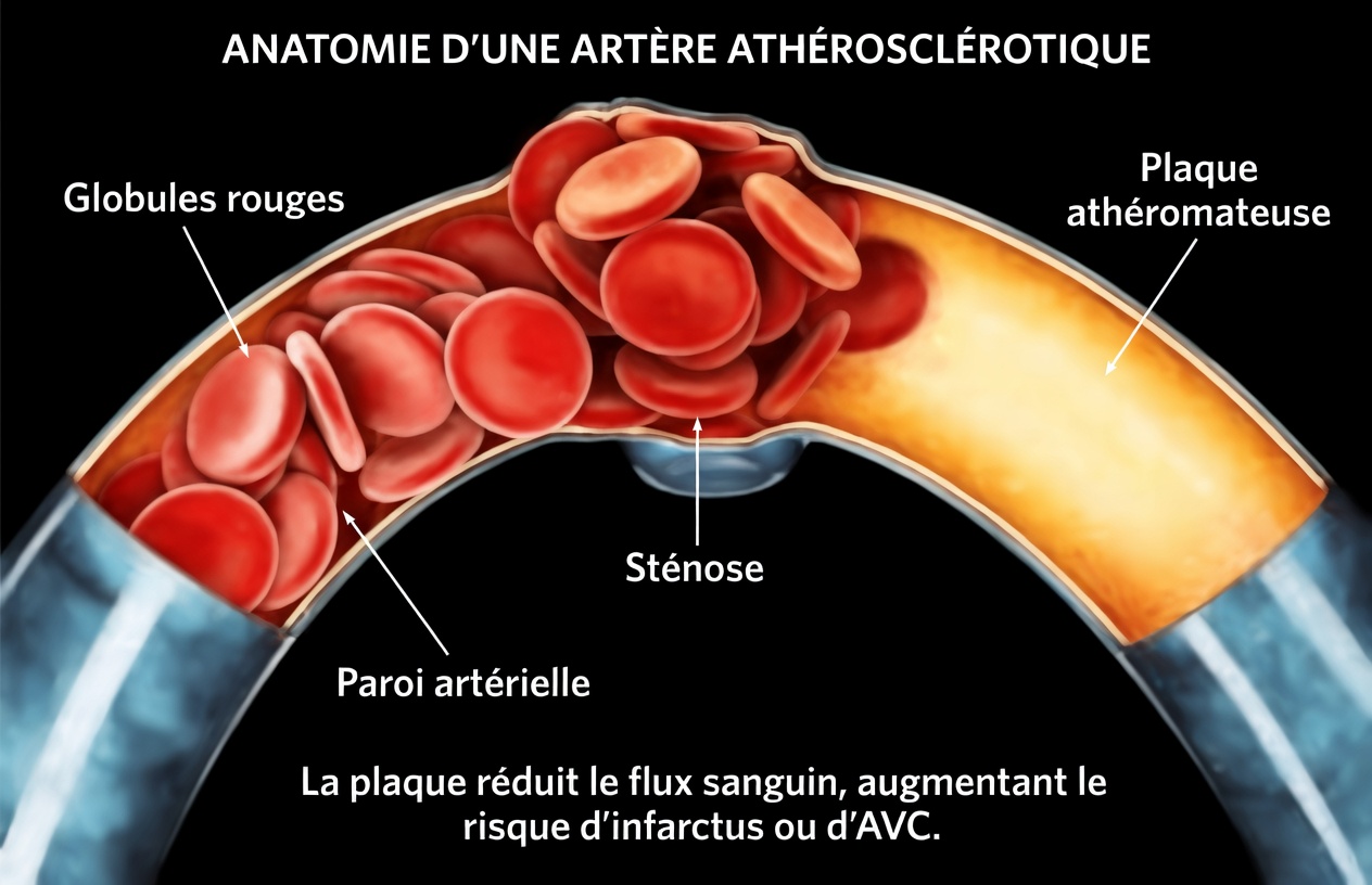 Les médecins alertent : 10 signes silencieux indiquant que les artères de vos jambes sont bouchées