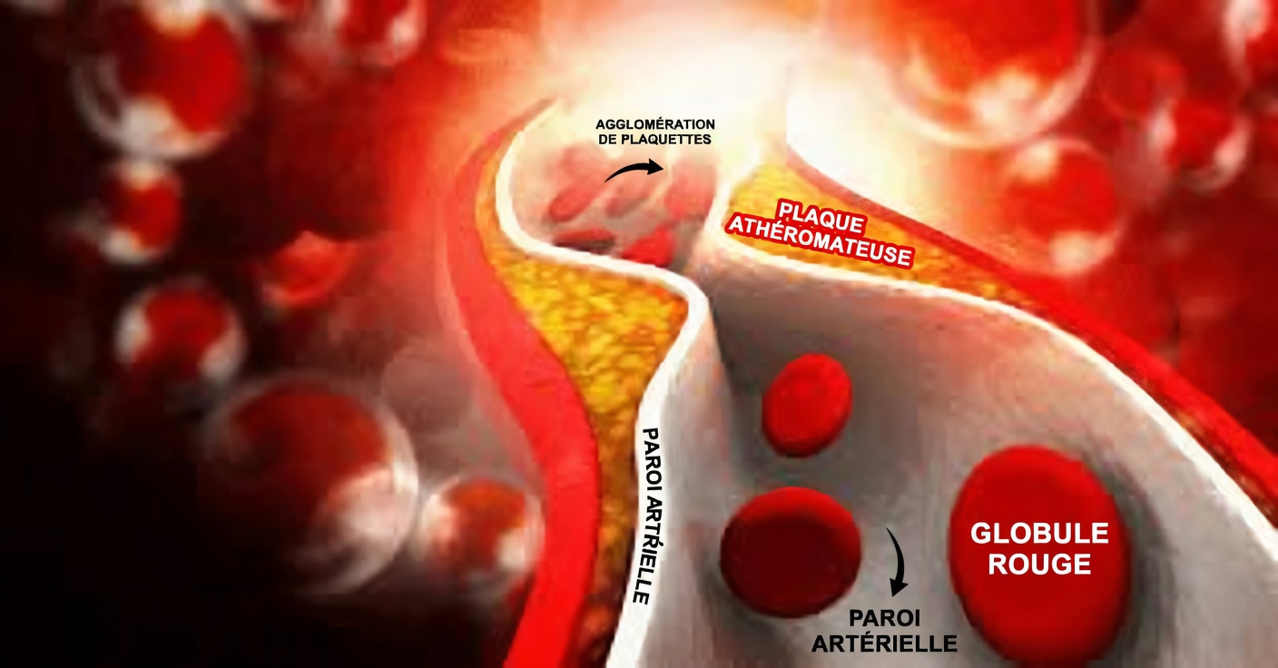 Une vitamine empêche l'accumulation de calcium dans les artères et le cœur