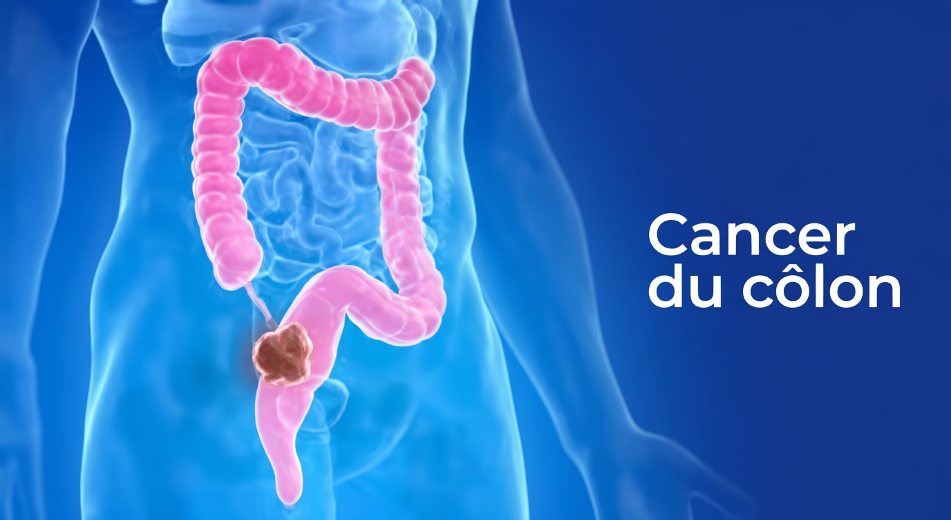 7 signes avant-coureurs subtils du cancer du côlon à ne jamais ignorer et comment la sensibilisation peut vous donner les moyens d’agir