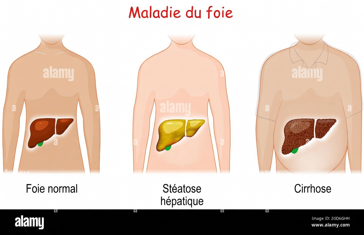 La menace silencieuse tapie dans votre foie : 8 signes avant-coureurs de la stéatose hépatique à reconnaître