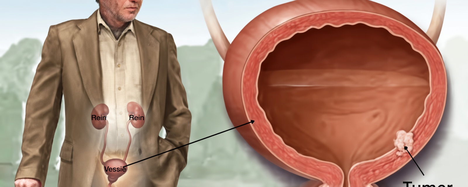 Le cancer de la vessie est un danger caché : 10 signes avant-coureurs à ne pas ignorer