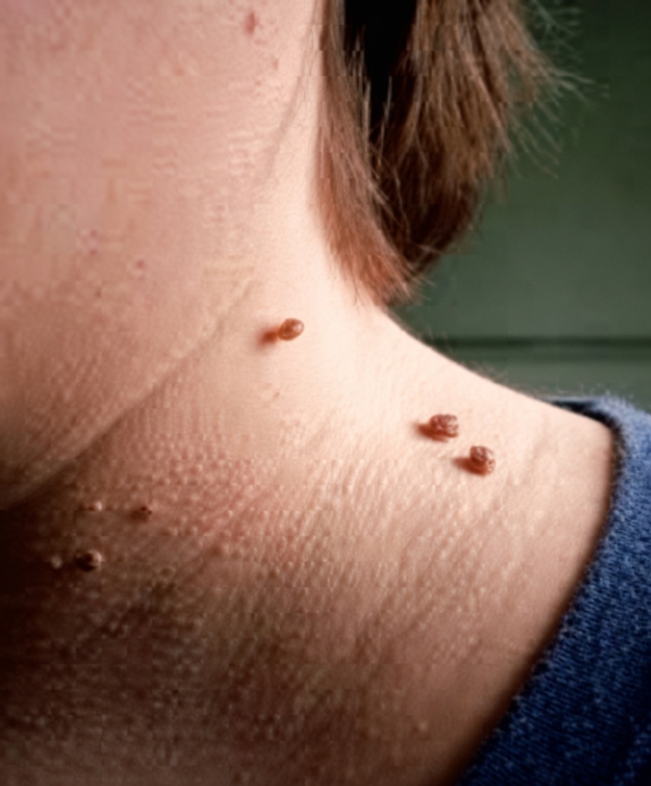 Avez-vous aussi développé ces petites bosses sur le cou ? Découvrez les causes fréquentes et des habitudes quotidiennes simples