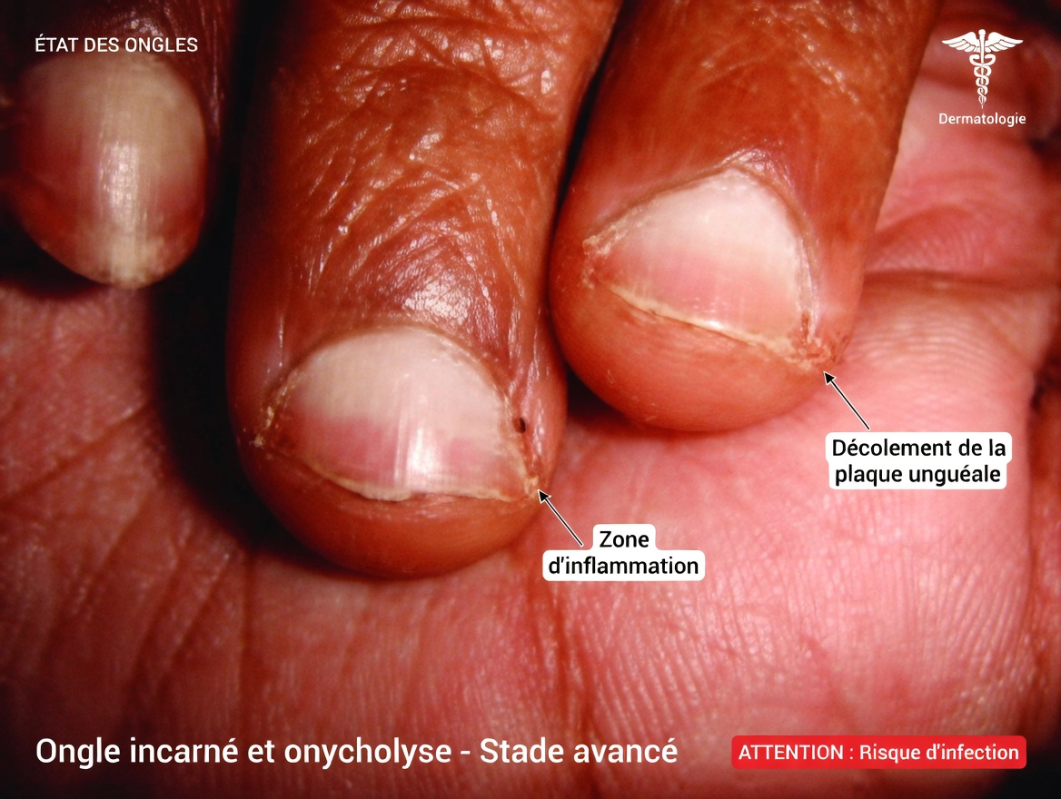 17 signes avant-coureurs de maladie rénale visibles sur votre corps – repérez-les avant qu’il ne soit trop tard