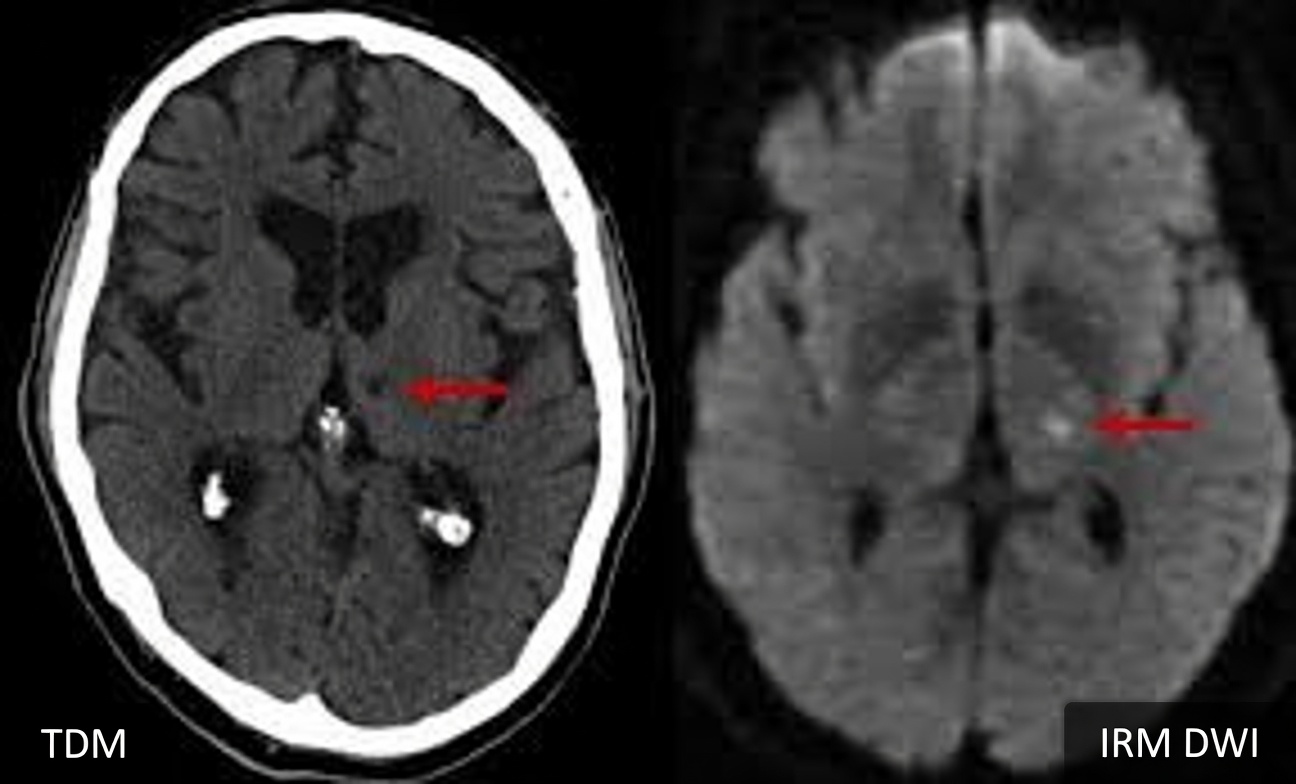 7 signes avant-coureurs d’un AVC lacunaire chez les plus de 60 ans que tout le monde ignore (surtout le n°4)