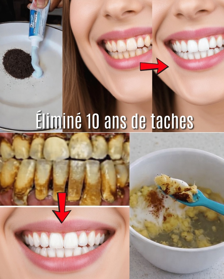 En seulement 2 minutes, effacez 10 ans de taches sur les dents – l’agent blanchissant naturel qui fonctionne vraiment