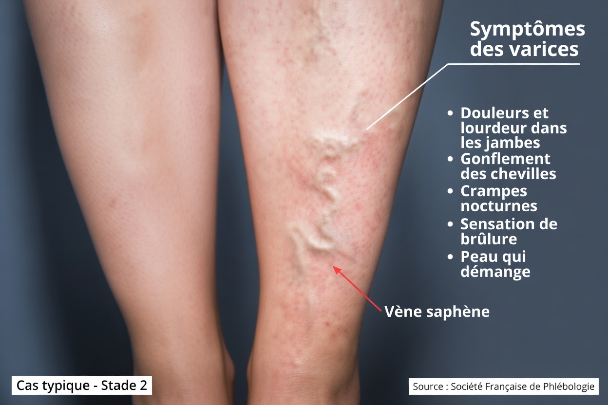 Pourquoi mes veines sont-elles soudainement saillantes et visibles ?