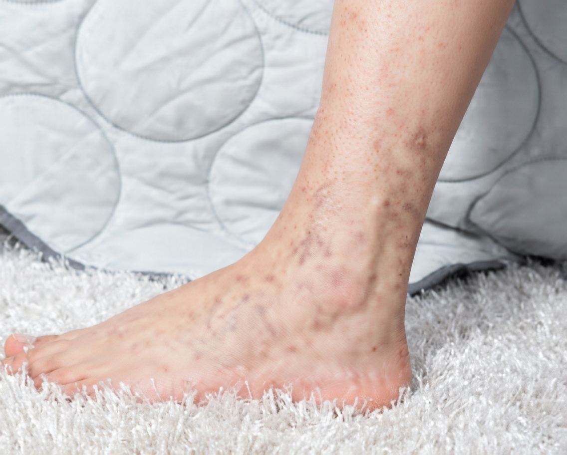 Femmes de plus de 60 ans : 10 signes d’alerte dans les jambes à ne pas ignorer – attention au n°7 !