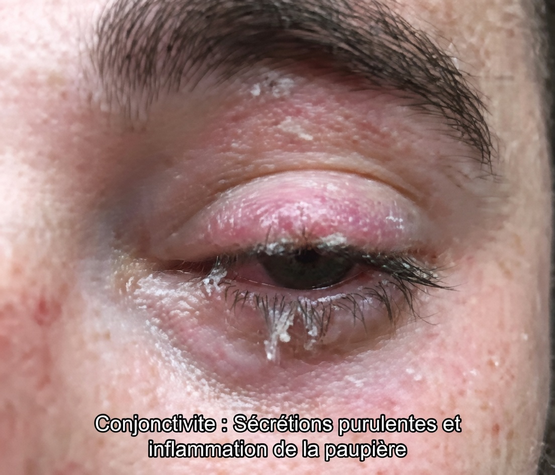 L’œil de votre tout-petit est-il collé par des sécrétions jaunes ? Méthodes sûres pour le nettoyer à la maison