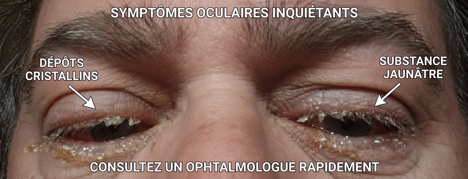 L’œil de votre tout-petit est-il collé par des sécrétions jaunes ? Méthodes sûres pour le nettoyer à la maison