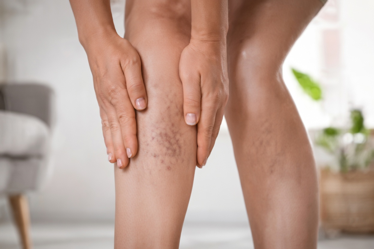 Les vitamines peuvent-elles dissoudre les caillots sanguins dans les jambes ? La vérité, les risques et ce qui aide vraiment