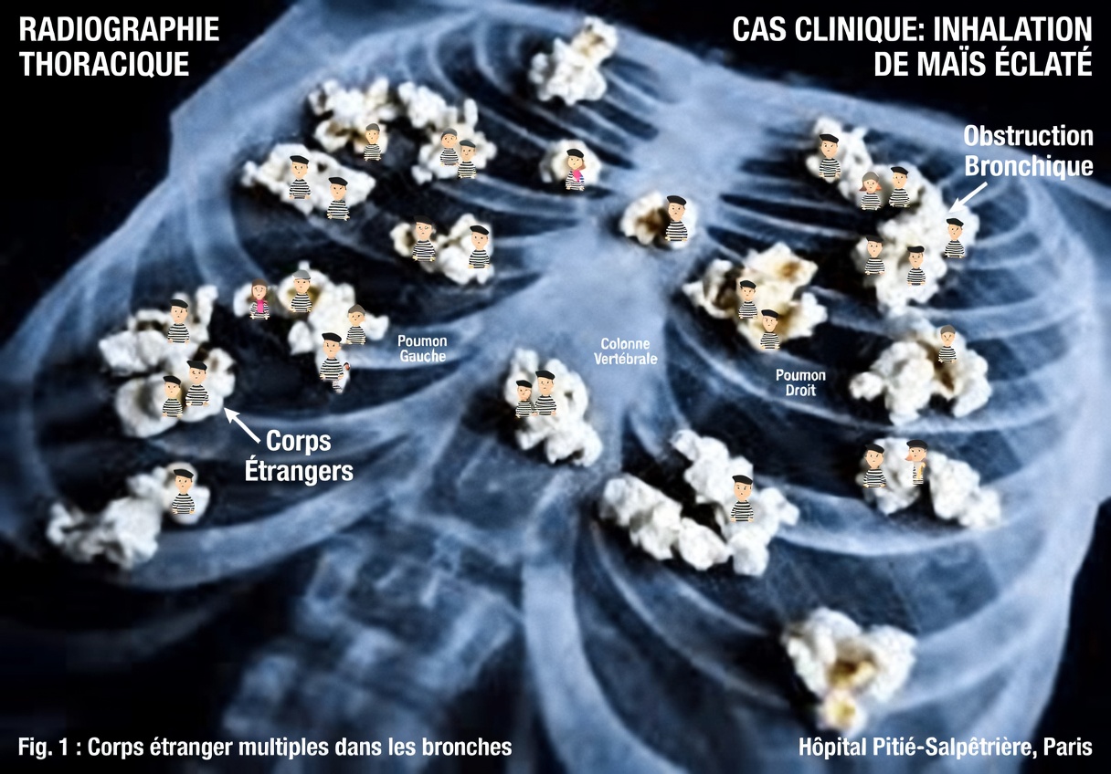 Alerte urgente : le « poumon du pop-corn » lié au vapotage provoque des dommages durables, avertissent des experts