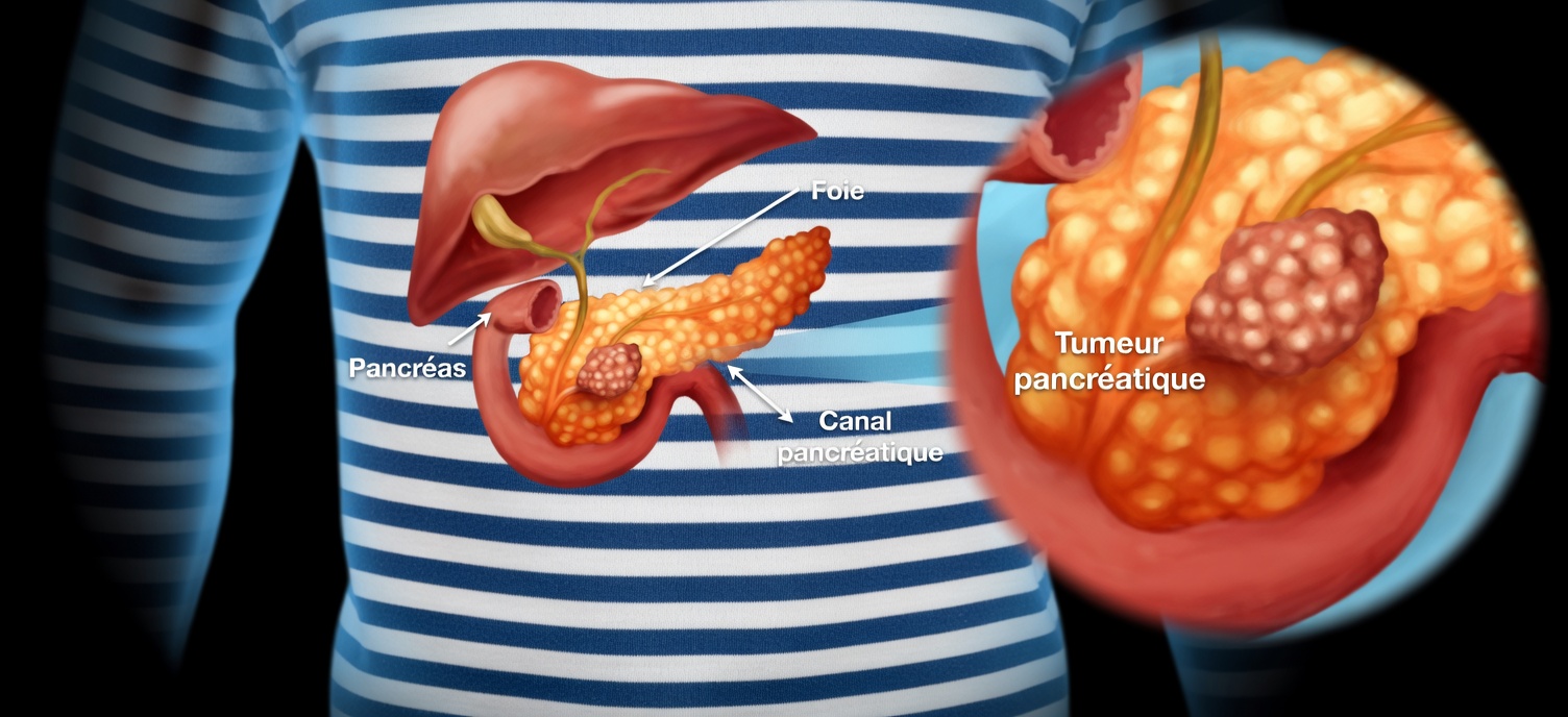 Cancer du pancréas : deux symptômes arrivés trop tard